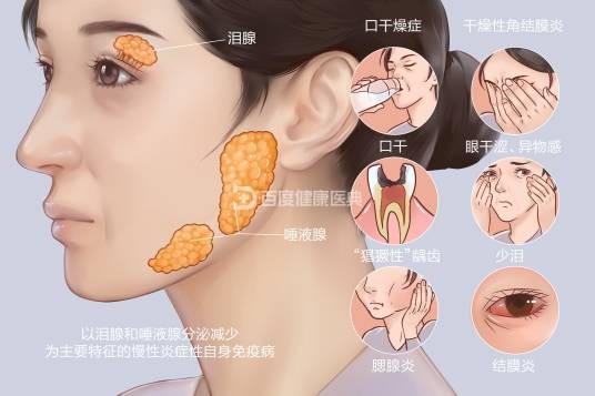 干燥综合征