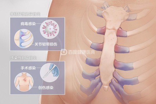 肋软骨炎