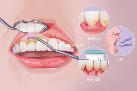 牙结石