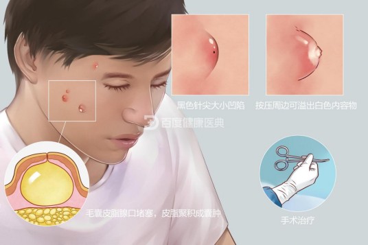 皮脂腺囊肿