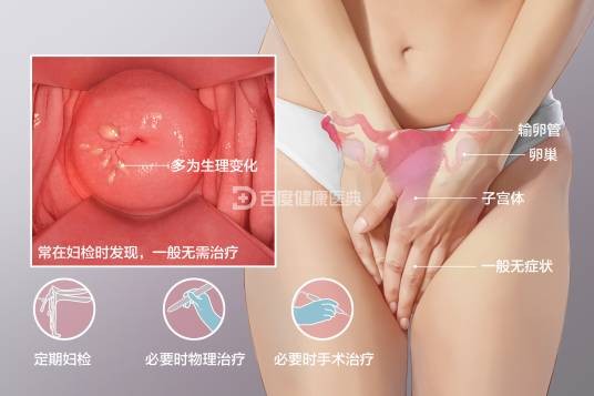 宫颈腺囊肿
