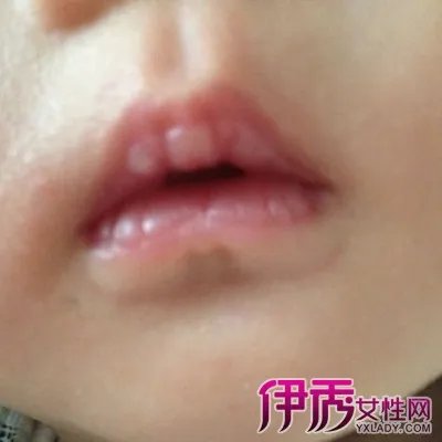 婴儿鹅口疮初期图片展示