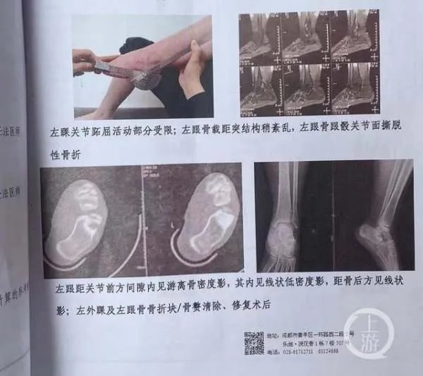 四川一女生遭体罚致残,校方补偿39万,你会接受这个补偿吗?
