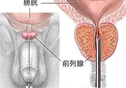 前列腺癌的预后如何？怎样预防？