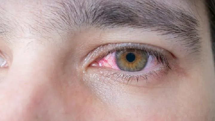红眼病的临床表现及治疗方法