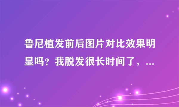 鲁尼植发前后图片对比效果明显吗？我脱发很长时间了，...