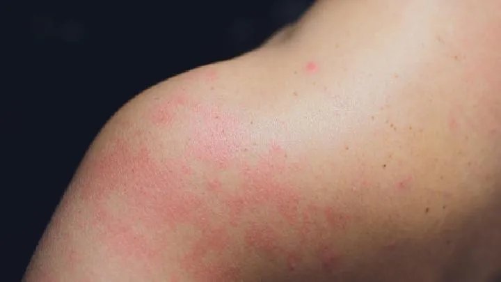 解析常见的引起成人痤疮的原因