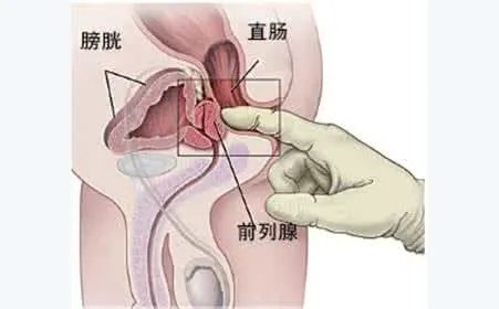 前列腺癌的预后如何?怎样预防?