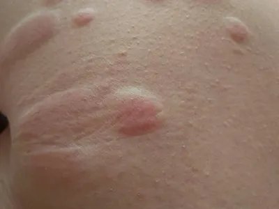 蚊子叮咬及引起的皮肤反应风团图片