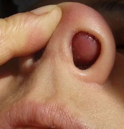 长期鼻窦炎该怎么治疗?