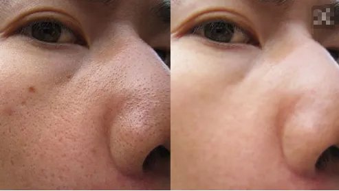 北京彩光嫩肤可以治疗毛孔粗大吗