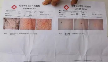 幼儿园孩子身上出现针眼,这是为何?