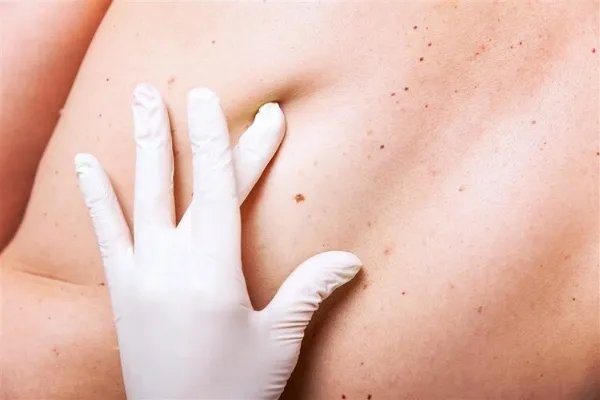 脸上的“招财痣”越长越大，原来是癌变信号？皮肤3个异常要留心