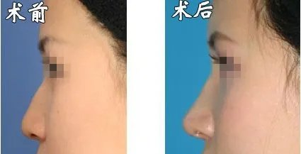 玻尿酸隆鼻大概多少钱呢