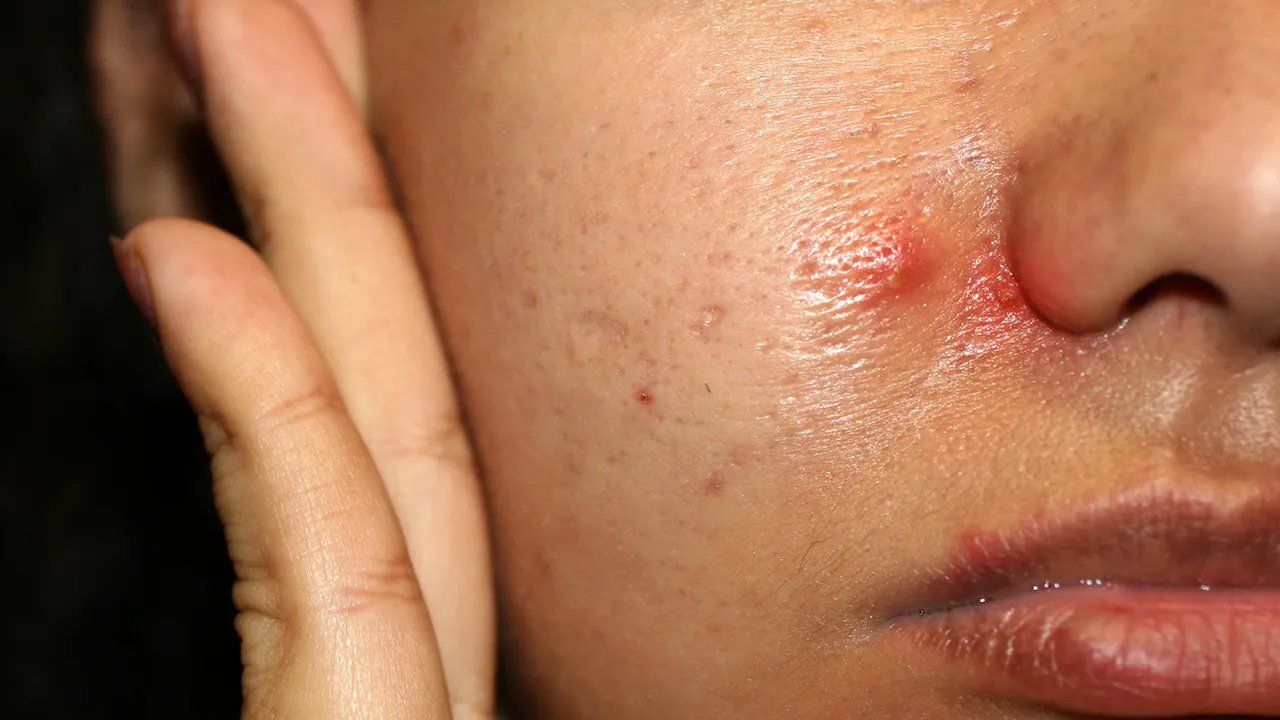脸上长痘痘该怎么办